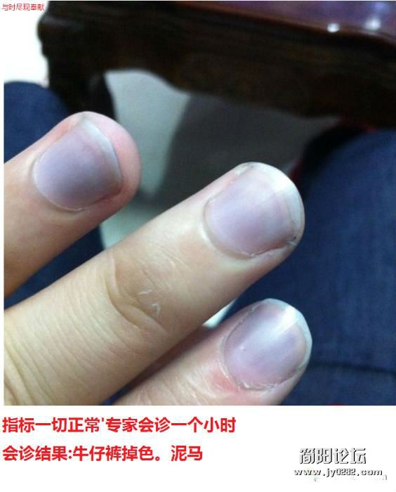 十指发紫，在医院抽了一针动脉一针静脉。.jpg
