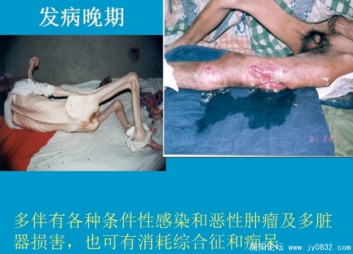 艾滋病防治