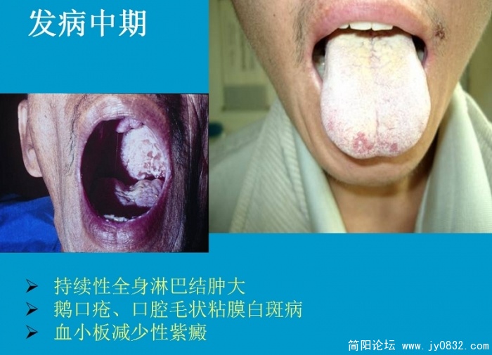 艾滋病防治