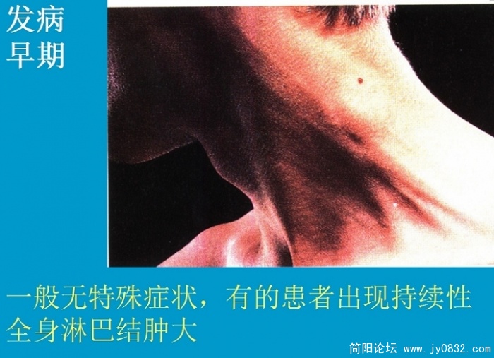 艾滋病防治